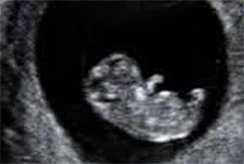 An early pregnancy ultrasound