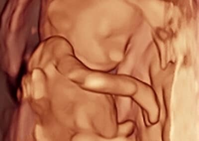 A 3D ultrasound