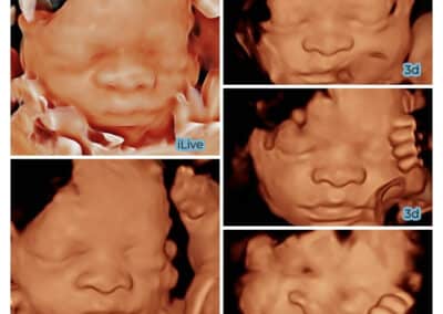 A 3D ultrasound
