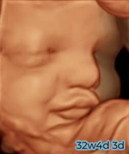 A 3D ultrasound