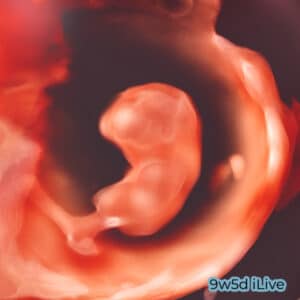 A 3D ultrasound