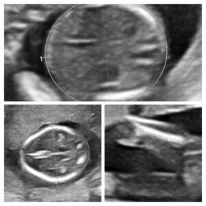 An early pregnancy ultrasound