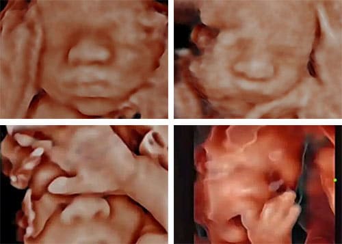 four examples of 5D ultrasound images