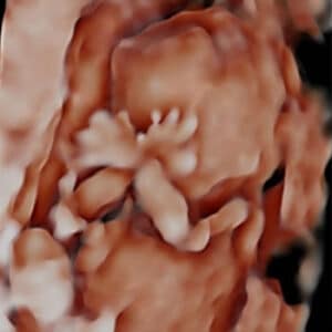 A 14-20 week old pregnancy ultrasound