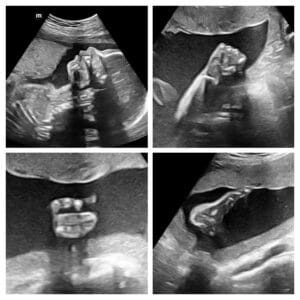 An early pregnancy ultrasound