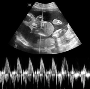 An early pregnancy ultrasound